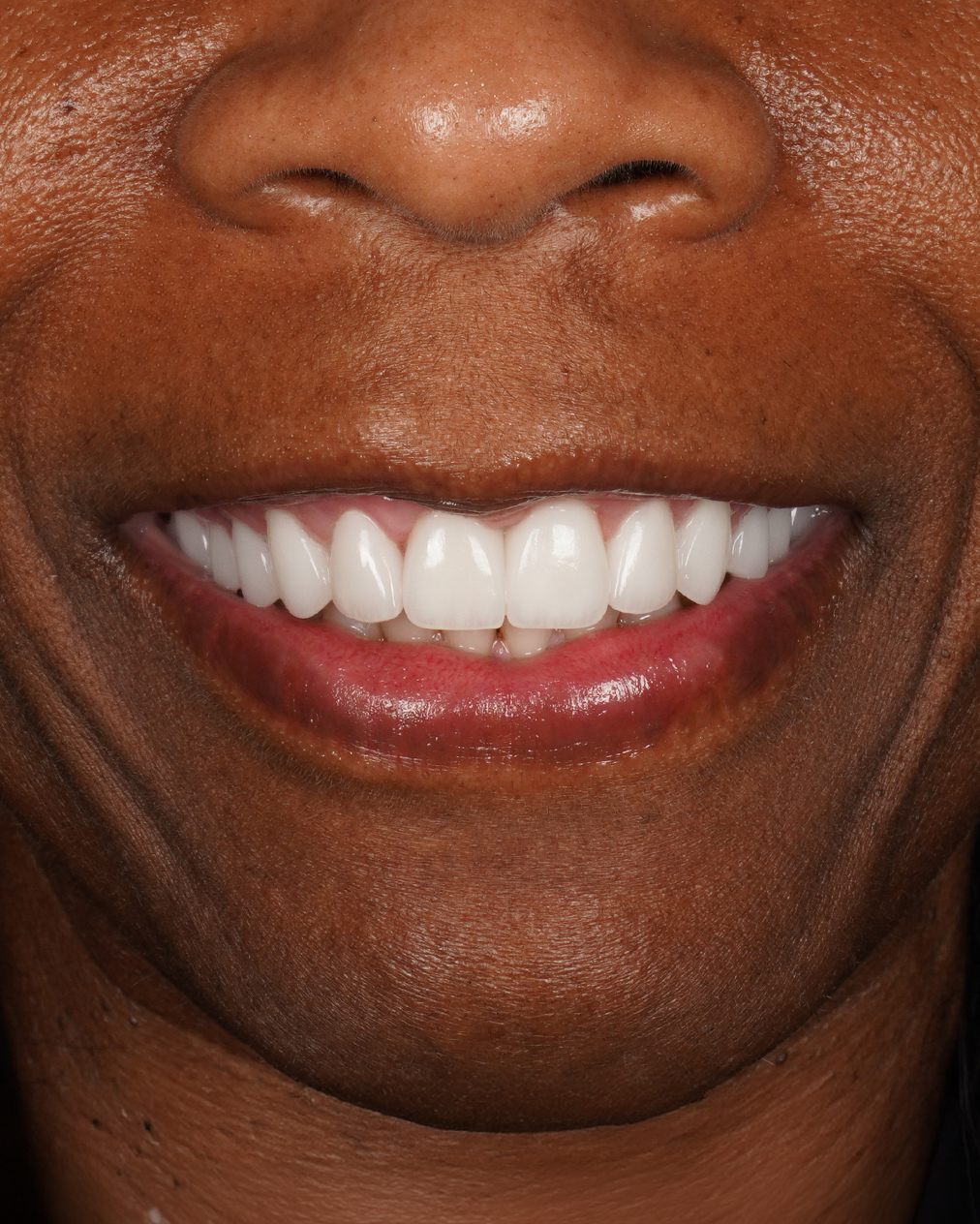 Porcelain Veneers — After